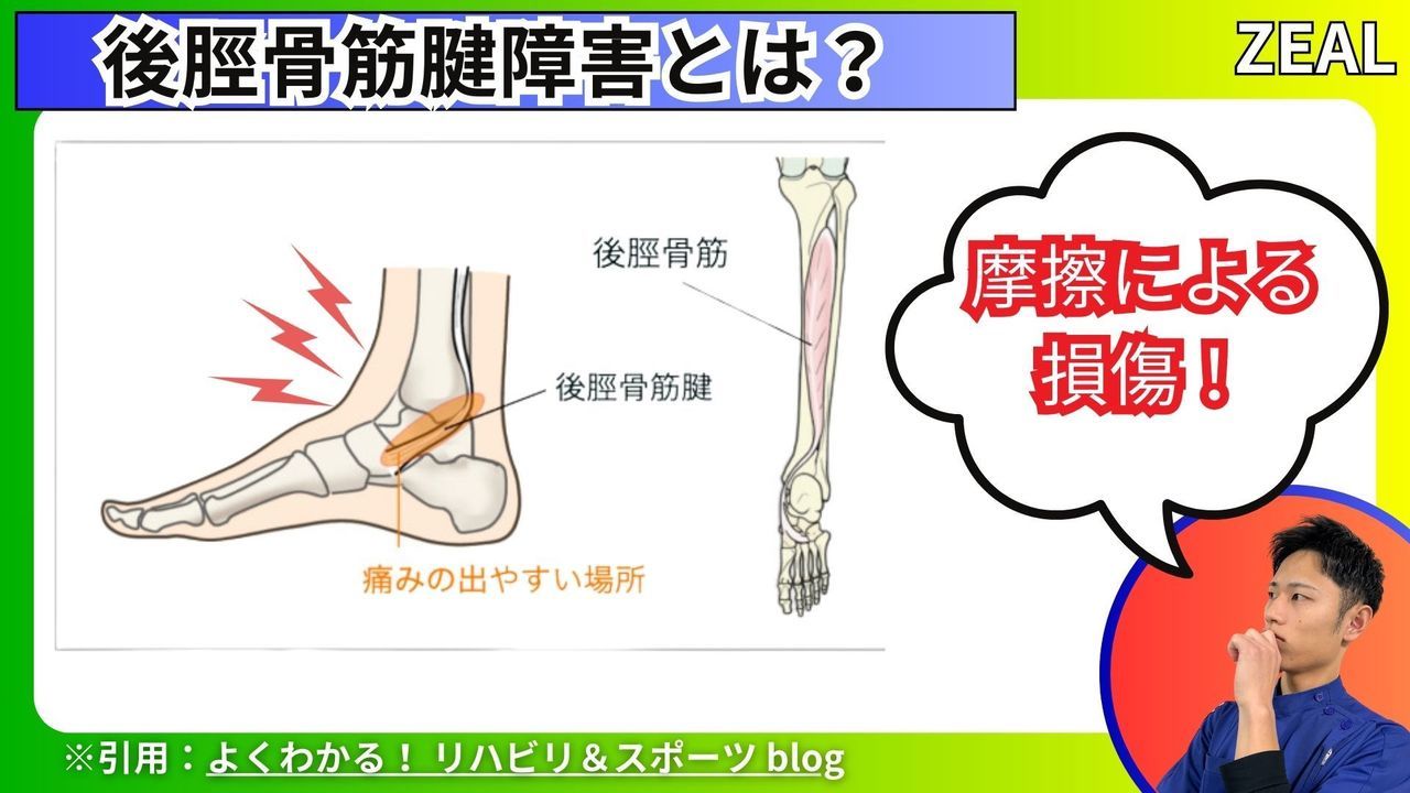 後脛骨筋腱障害とは？