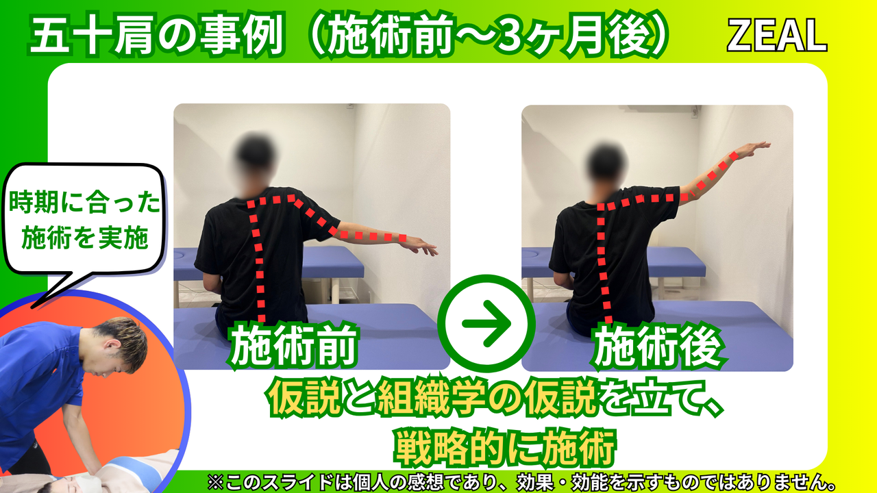 四十肩・五十肩の成功事例｜玉野市ジール鍼灸整骨院