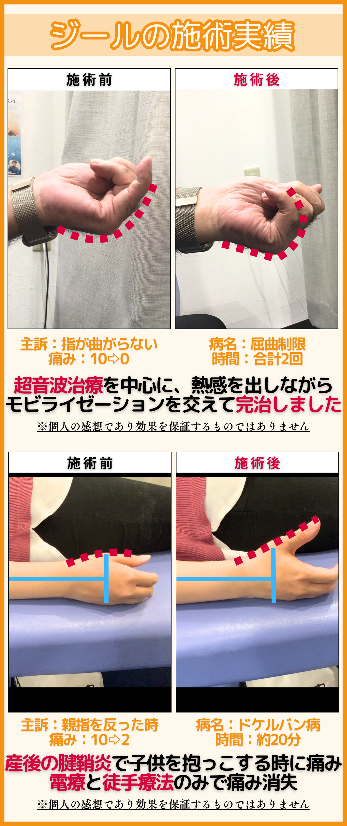 腱鞘炎（ばね指・ドケルバン病）の施術実績｜玉野市ジール鍼灸整骨院