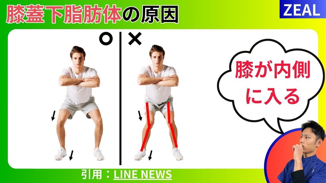 膝蓋下脂肪体の原因は膝が内側に入ること？｜玉野市ジール鍼灸整骨院