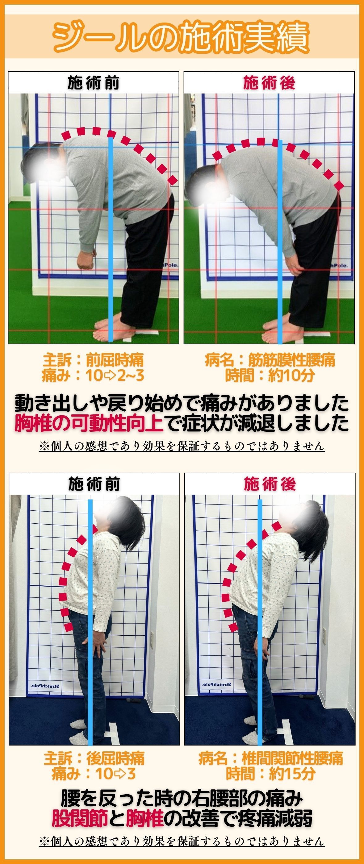 椎間終板炎の改善事例｜玉野市ジール鍼灸整骨院
