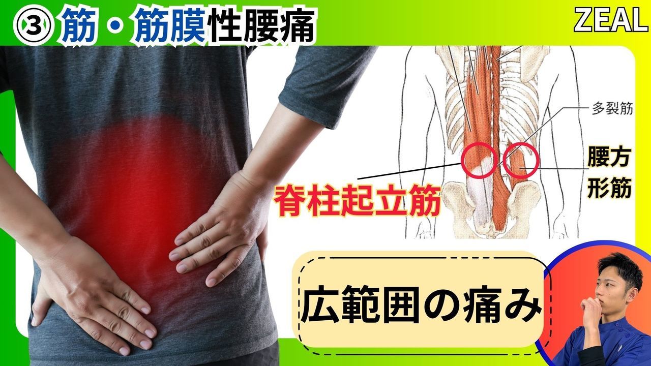 筋筋膜性腰痛｜玉野市ジール鍼灸整骨院