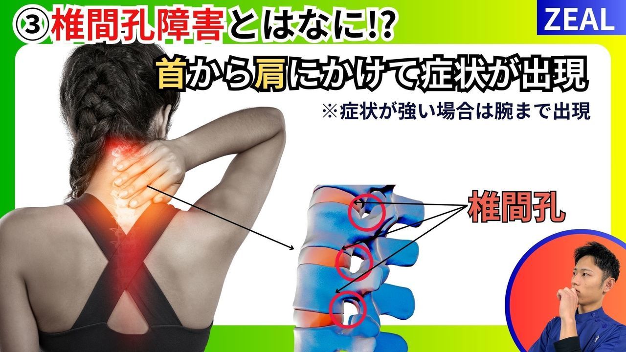 首の痛み椎間孔障害とは何か？｜玉野市ジール鍼灸整骨院