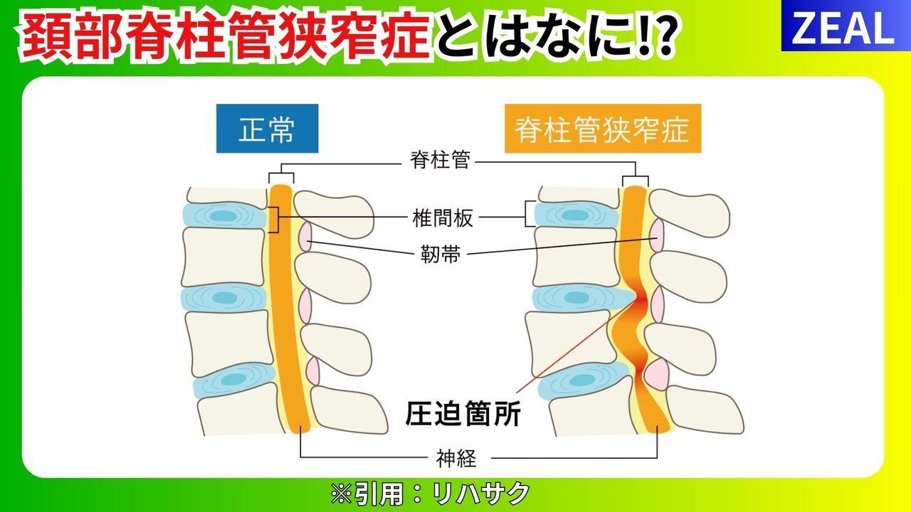 首の痛み狭窄症｜玉野市ジール鍼灸整骨院