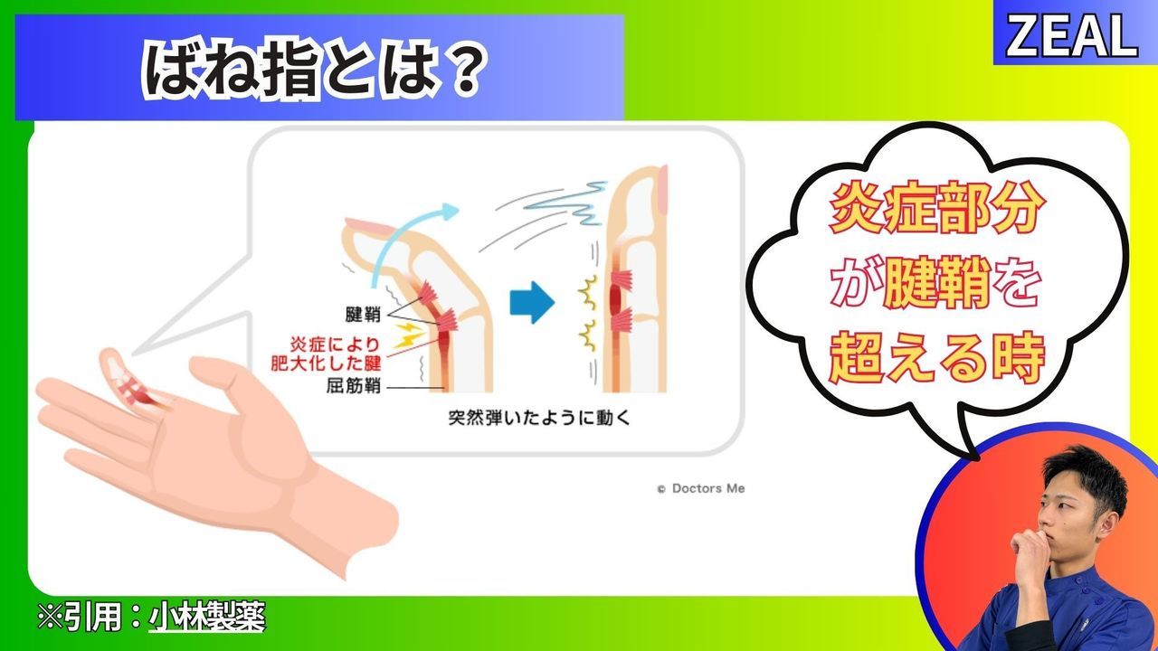 腱鞘炎（ばね指）とは｜玉野市ジール鍼灸整骨院