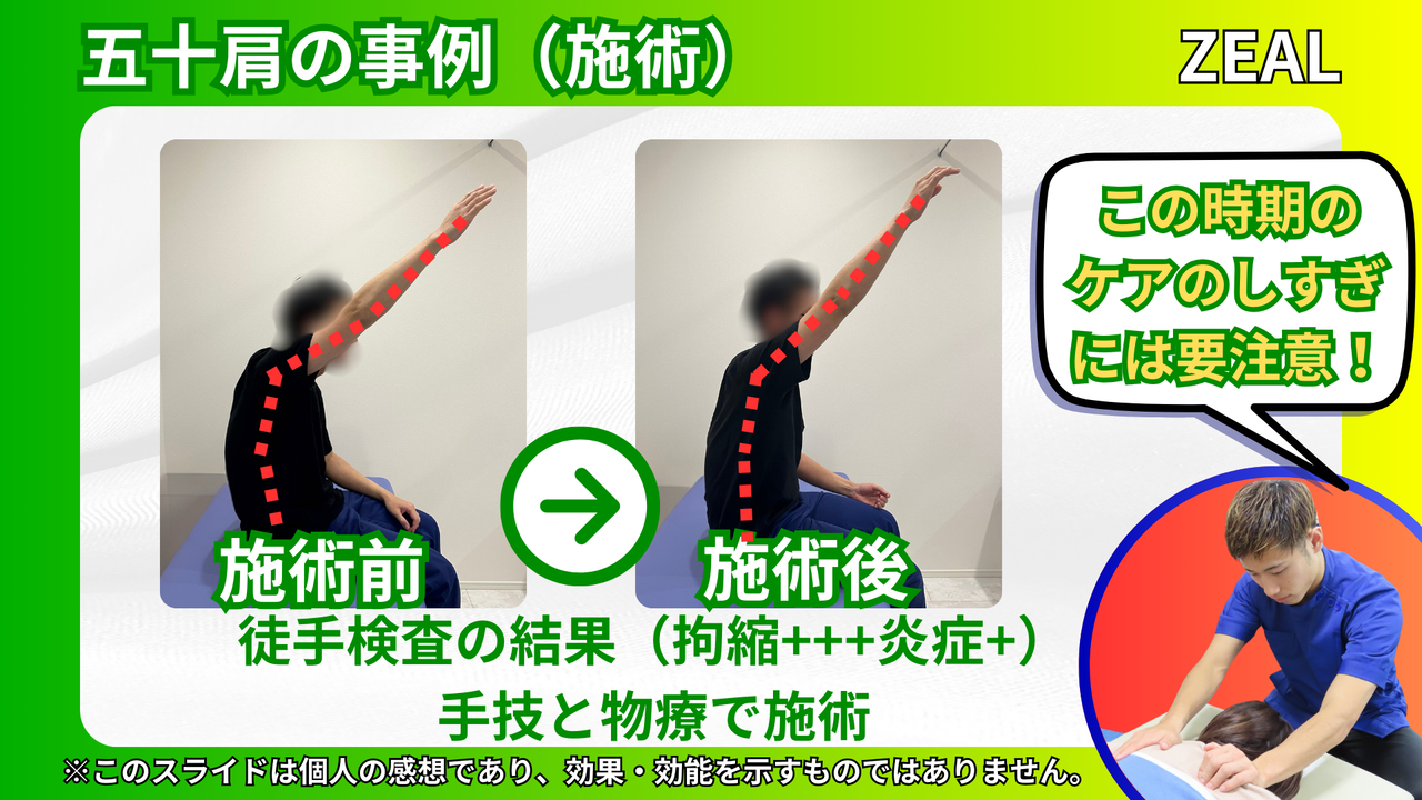 四十肩・五十肩の事例｜玉野市ジール鍼灸整骨院