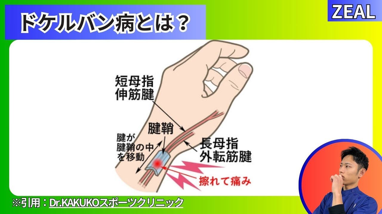 腱鞘炎（ドケルバン病）とは｜玉野市ジール鍼灸整骨院
