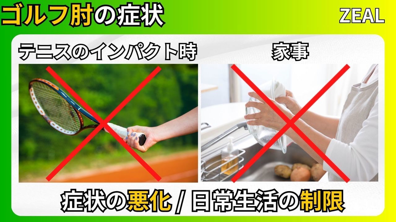 ゴルフ肘（上腕骨内側上顆炎）の症状②｜玉野市ジール鍼灸整骨院