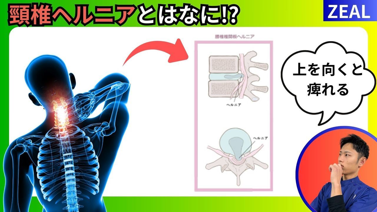 頸椎ヘルニアとは？｜玉野市田井ジール鍼灸整骨院