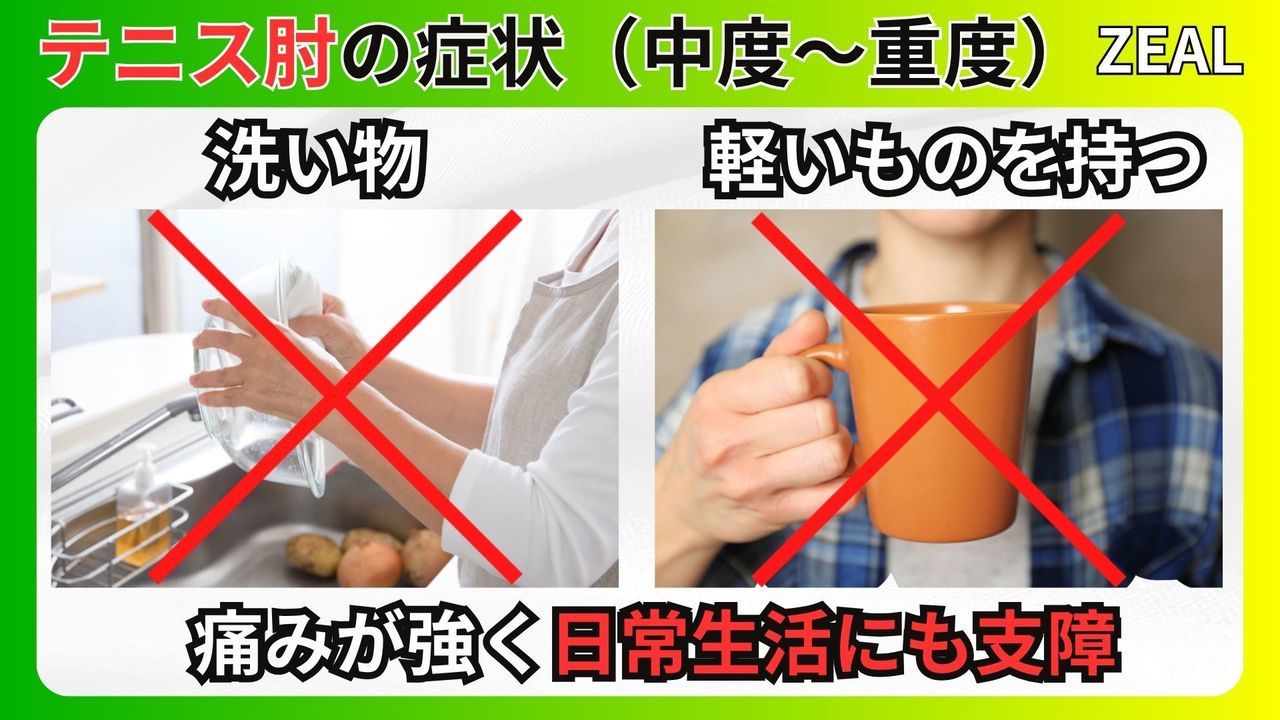 テニス肘（上腕骨外側上顆炎）の中長期症状｜玉野市ジール鍼灸整骨院