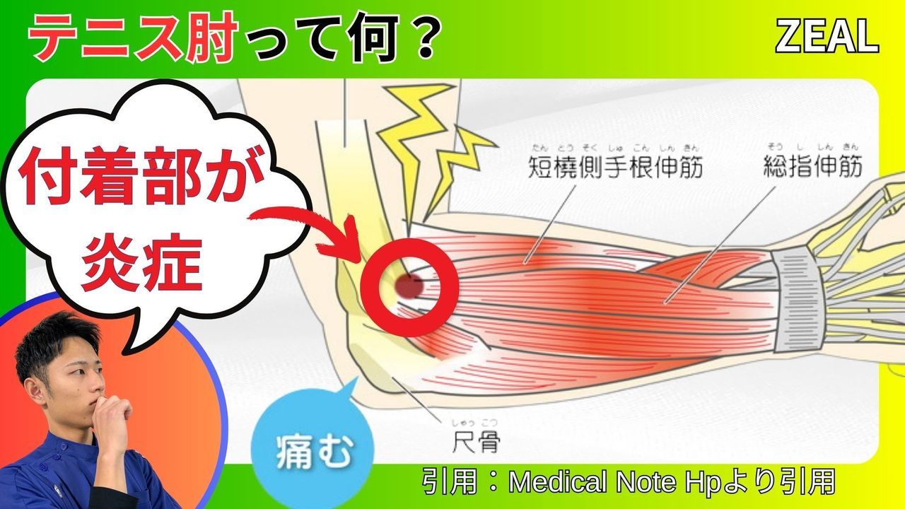 テニス肘（上腕骨外側上顆炎）とは｜玉野市ジール鍼灸整骨院