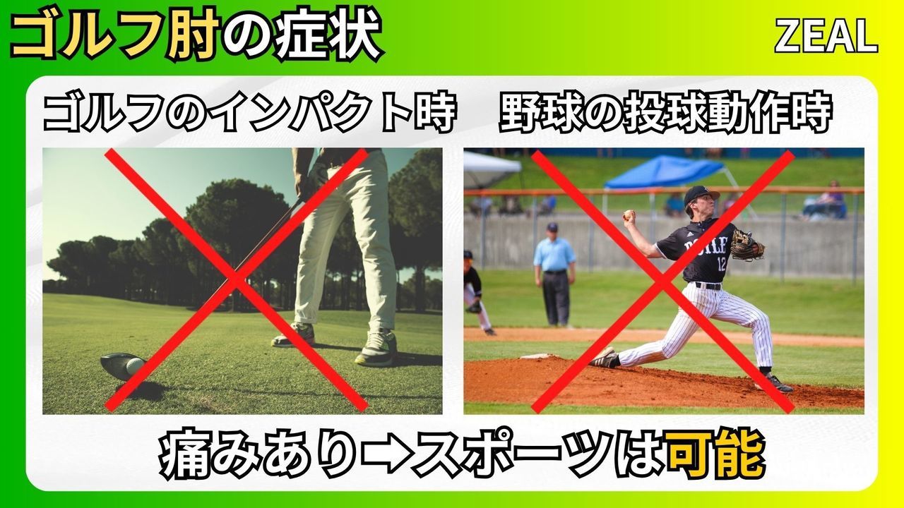 ゴルフ肘（上腕骨内側上顆炎）の症状｜玉野市ジール鍼灸整骨院