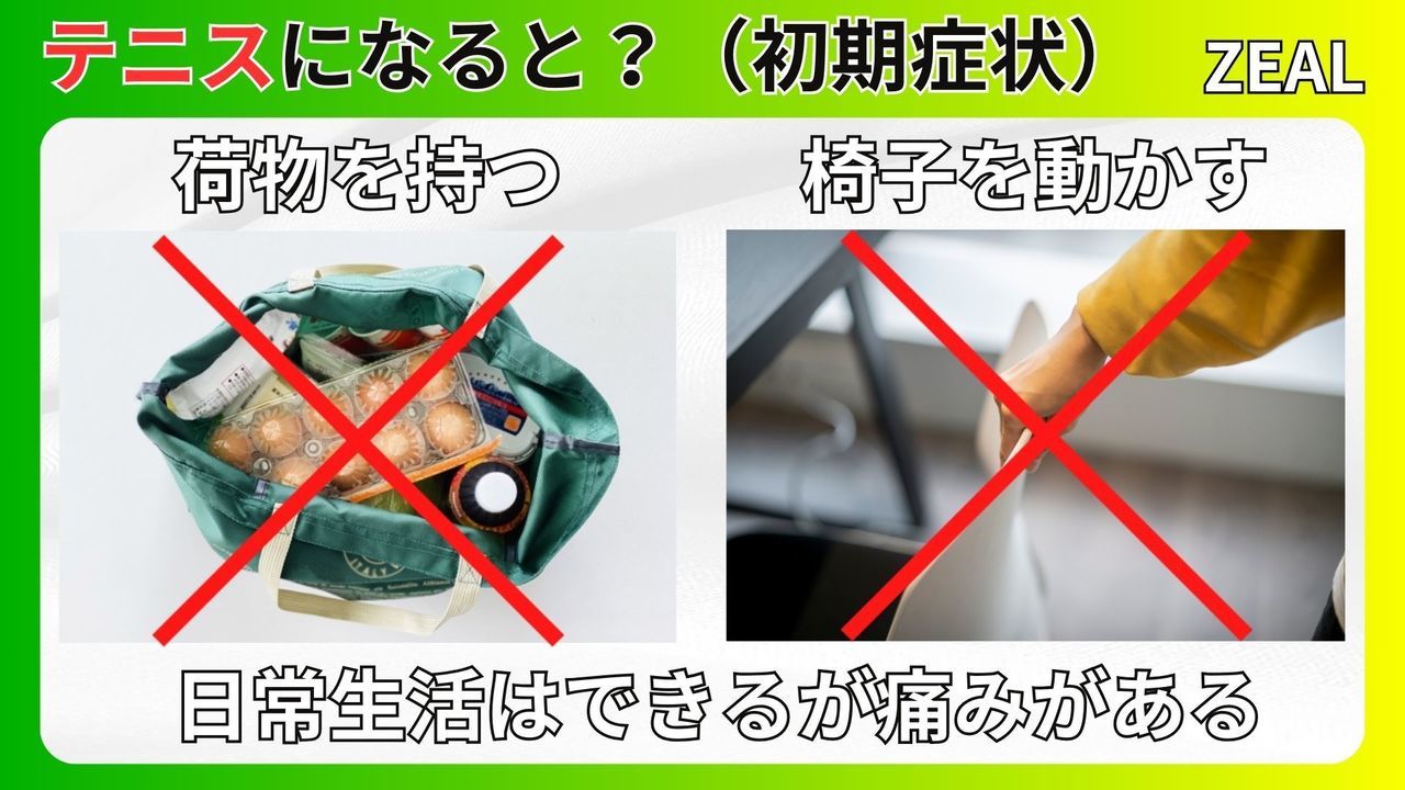 テニス肘（上腕骨外側上顆炎）の初期症状｜玉野市ジール鍼灸整骨院