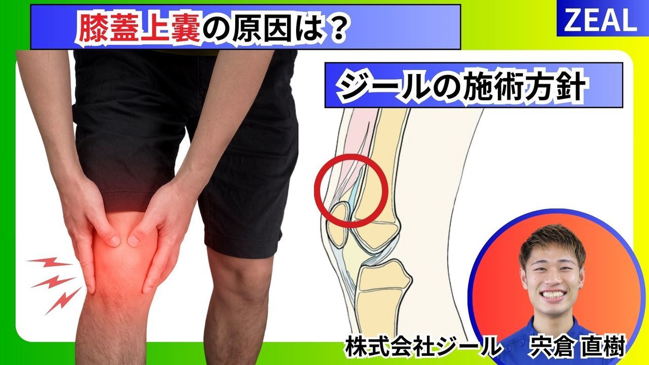 膝蓋上嚢の原因｜玉野市ジール鍼灸整骨院