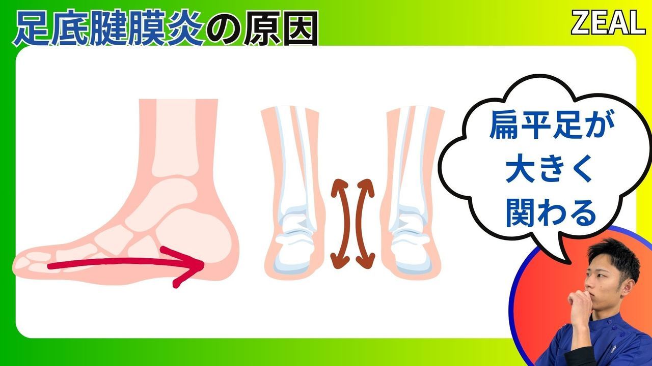 足底腱膜炎の原因｜玉野市ジール鍼灸整骨院