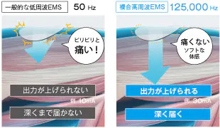 EMSとは？｜玉野市ジール鍼灸整骨院