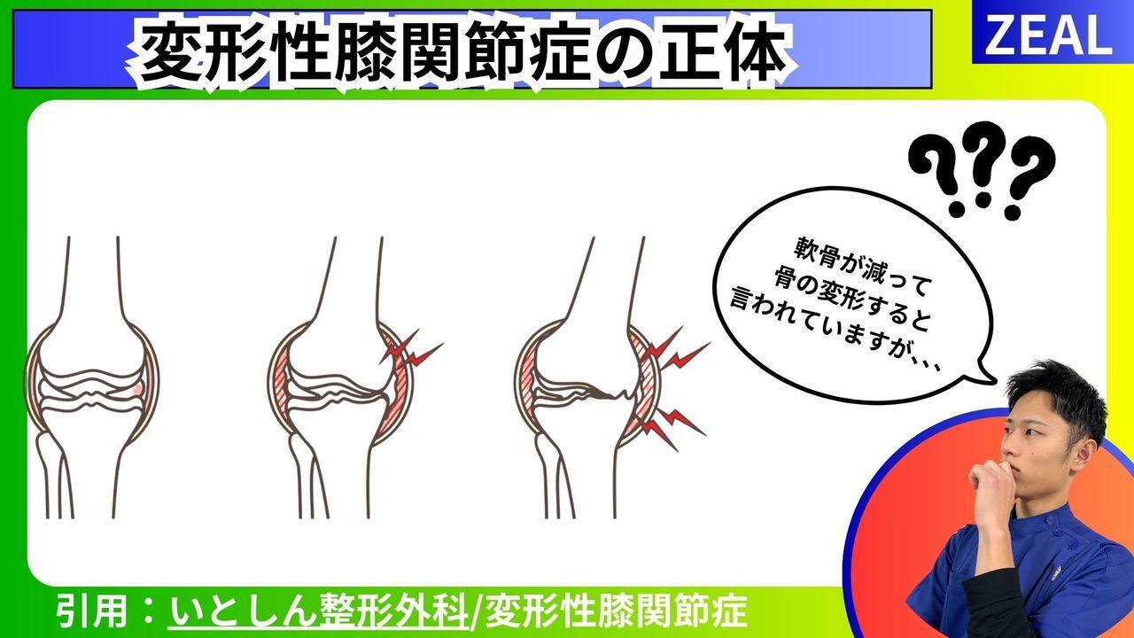 変形性膝関節症の正体｜玉野市ジール鍼灸整骨院