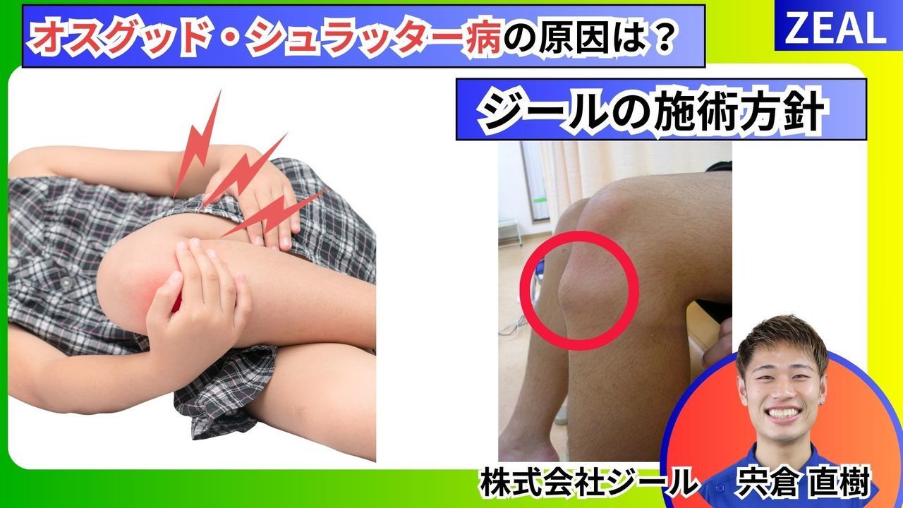 オスグッドシュラッター