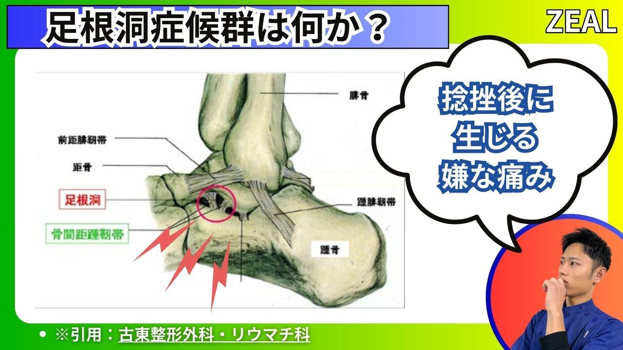 岡山県玉野市田井３丁目１１８８−１｜ジール鍼灸整骨院玉野院｜足根洞症候群とは