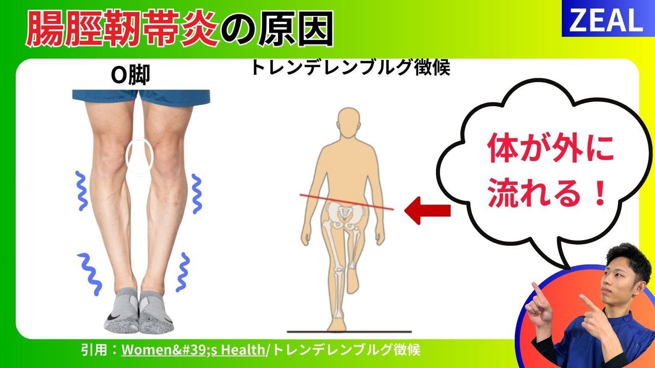 ランナー膝・腸脛靭帯炎の原因｜玉野市ジール鍼灸整骨院