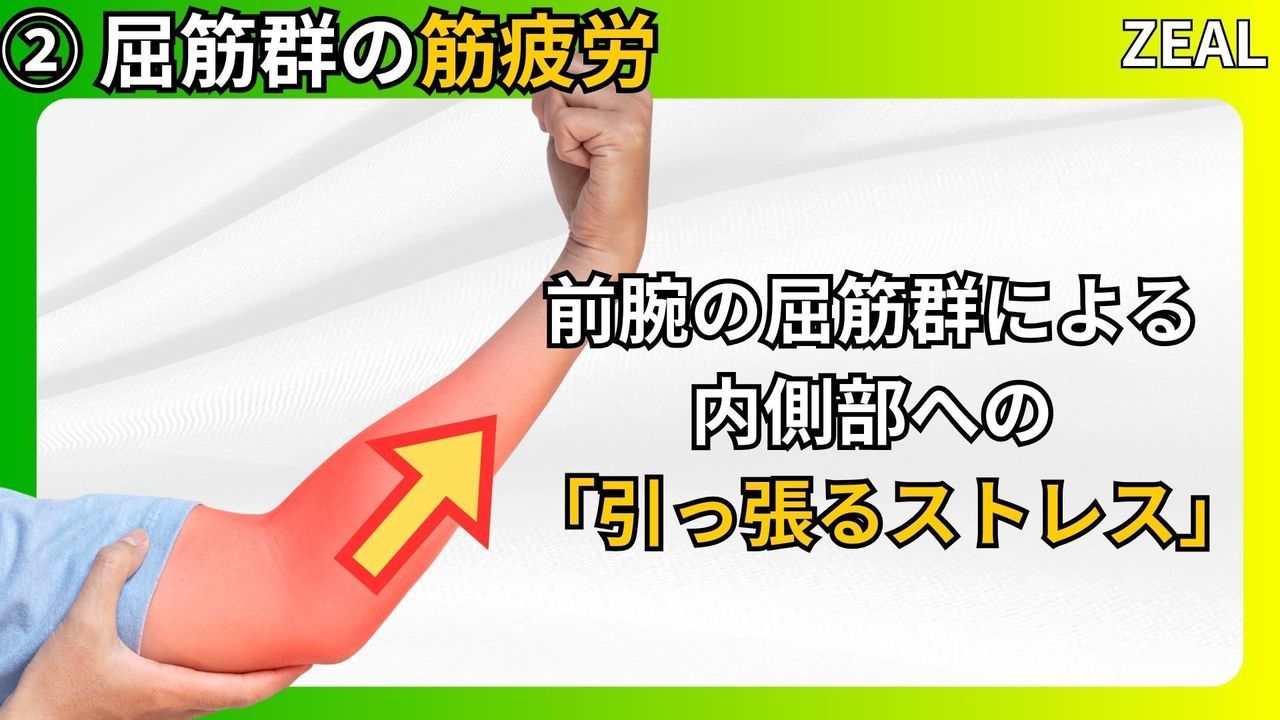 ゴルフ肘（上腕骨内側上顆炎）の原因筋疲労｜玉野市ジール鍼灸整骨院