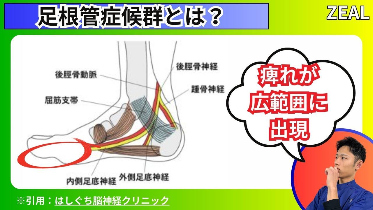 岡山県玉野市田井３丁目１１８８−１｜ジール鍼灸整骨院玉野院｜足根管症候群とは