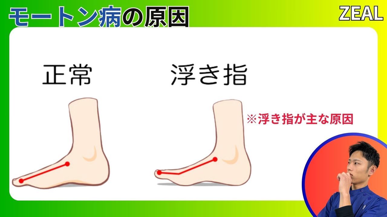 モートン病の原因｜玉野市ジール鍼灸整骨院