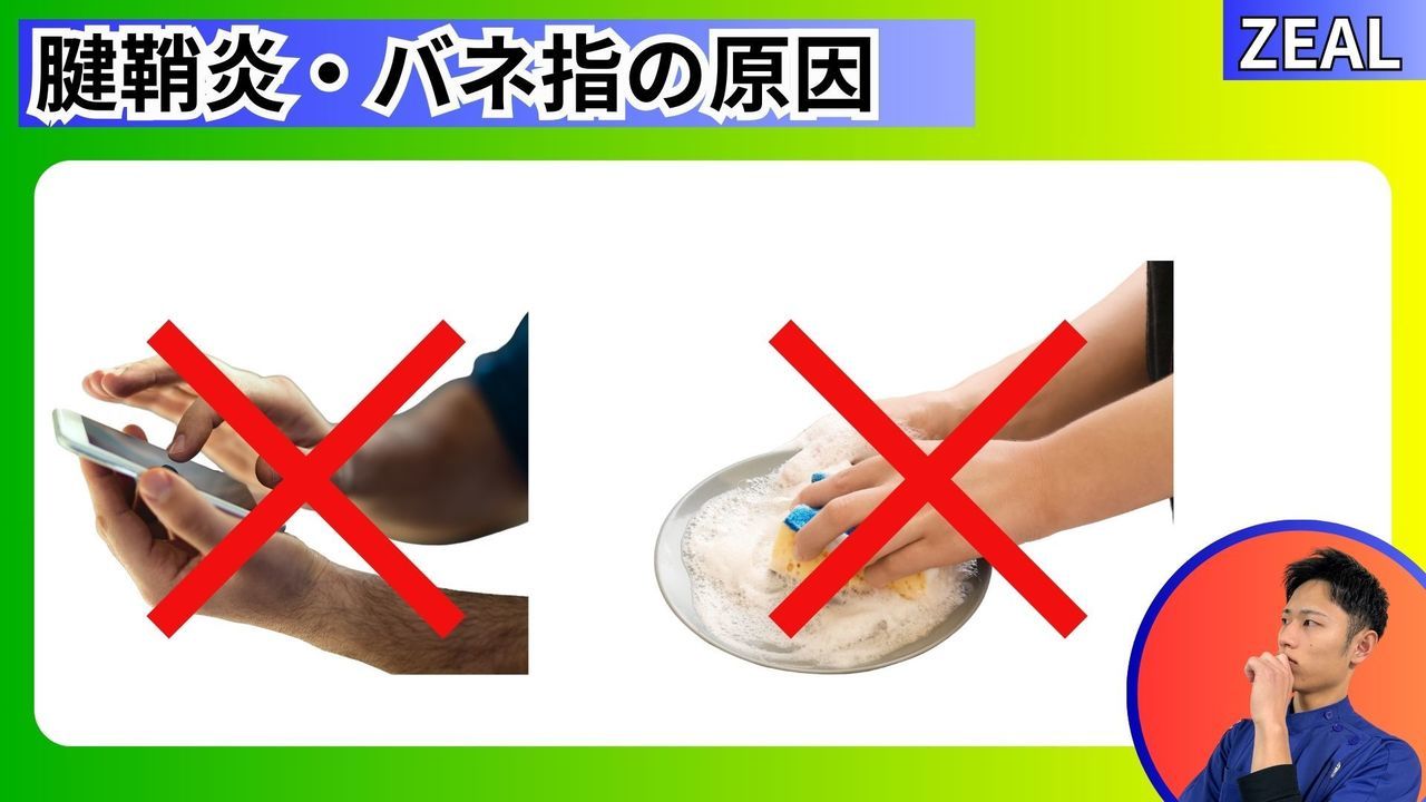 腱鞘炎（ばね指・ドケルバン病）の原因｜玉野市ジール鍼灸整骨院