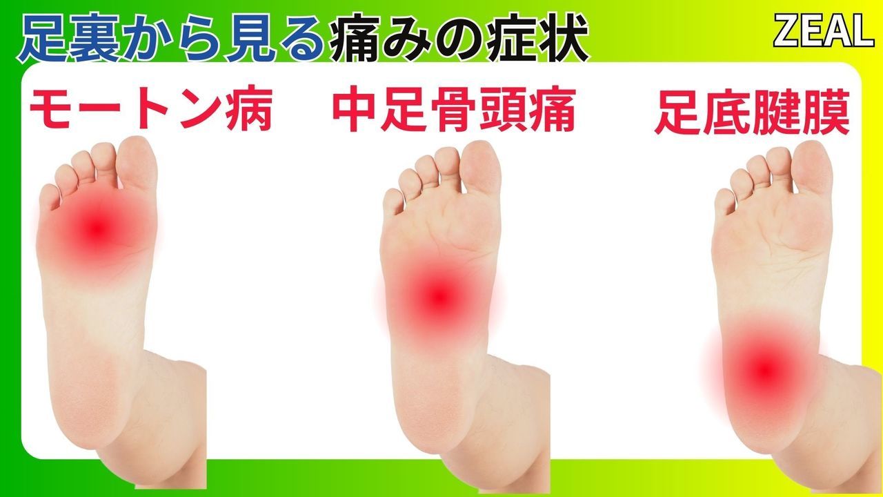 足の裏の痛みの状態（足底腱膜炎・モートン・アキレス腱炎）｜玉野市ジール鍼灸整骨院