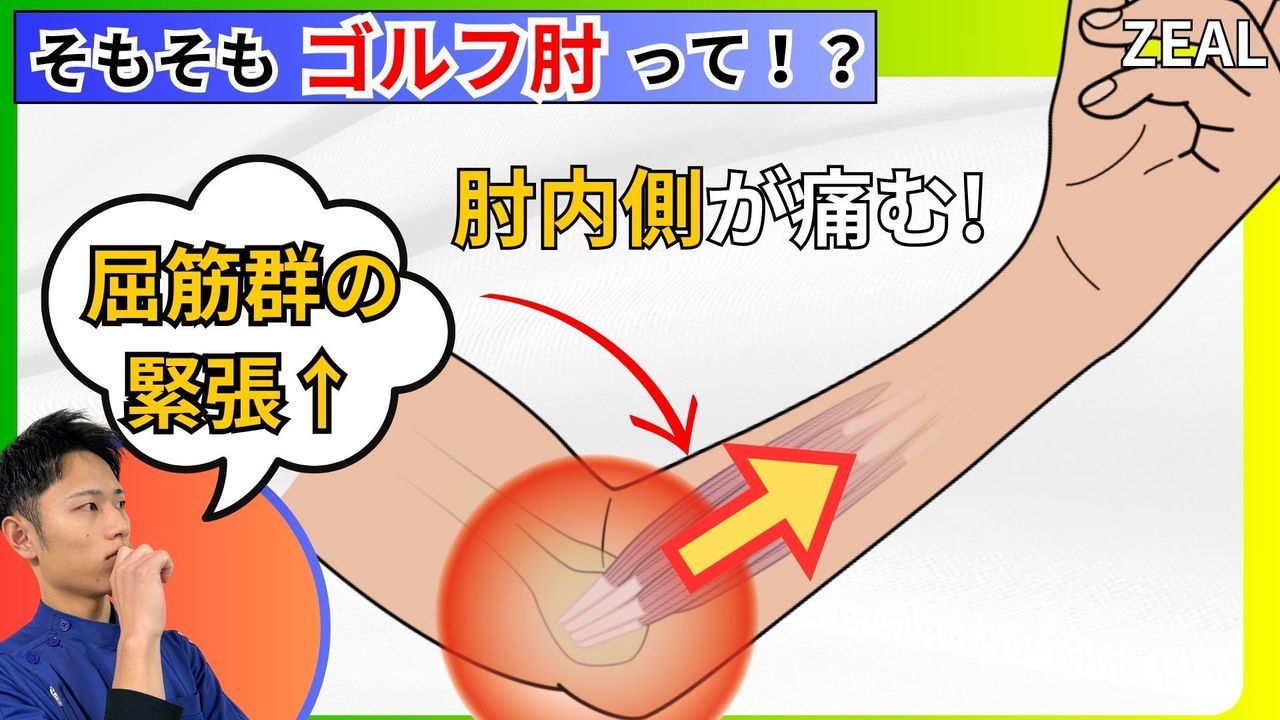 ゴルフ肘（上腕骨内側上顆炎）とは｜玉野市ジール鍼灸整骨院